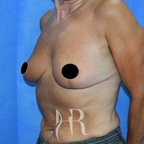 HR Plastic Surgery - Breast Reduction patient after 12